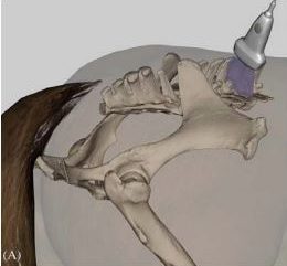 Ultrasonography for transitional vertebrae