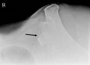 Radiographic view of tuber coxae fracture