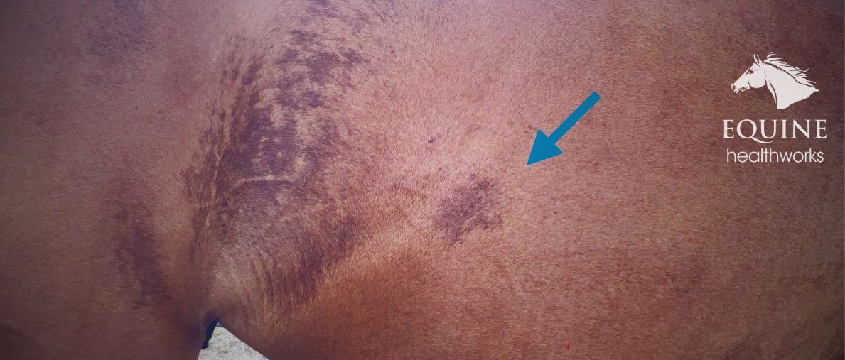 Sweat patch at an injury site post-BEMER